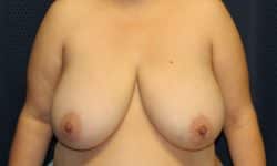 Breast Reduction 02 Before