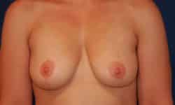 Breast Implant Removal 01 After