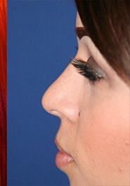 Rhinoplasty 05 After 2