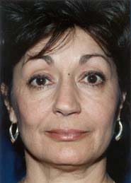 Facelift 05 Before 1