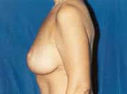 Breast Lift 05 After 2