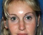 Chin Implants 02 After