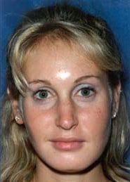 Chin Implants 02 After 1