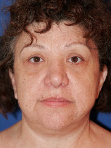 Neck Lift 02 After 1