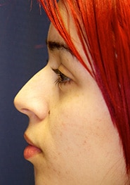 Rhinoplasty 05 Before 2