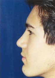 Rhinoplasty 01 After 3