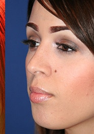 Rhinoplasty 05 After 1