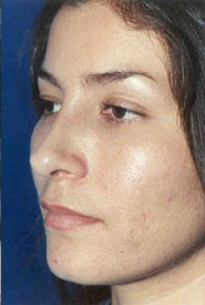 Rhinoplasty 09 After 2