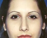 Rhinoplasty 07 After