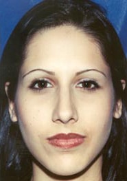 Rhinoplasty 07 After 1