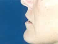 Lip Lift / Augmentation 03 Before 2