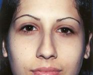 Rhinoplasty 07 Before