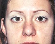 Buccal Fat Removal 01 Before