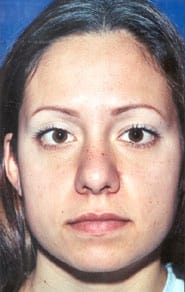 Buccal Fat Removal 01 Before 1