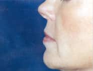 Lip Lift / Augmentation 02 Before 2
