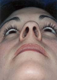 Rhinoplasty 04 Before 3