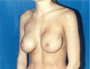 Breast Augmentation Revision 02 Before 2