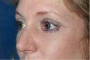 Eyelid Surgery 08 After 2