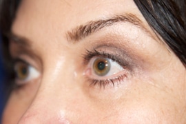 Eyelid Surgery 02 After 2