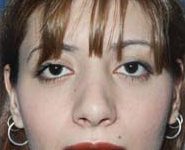 Rhinoplasty 03 After