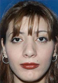 Rhinoplasty 03 After 1