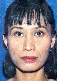 Otoplasty 01 After 1