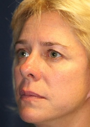 Facelift 02 Before 2