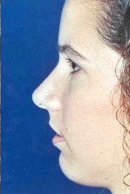 Rhinoplasty 08 After 3