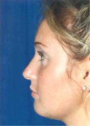 Chin Implants 02 After 2