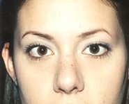 Buccal Fat Removal 01 After