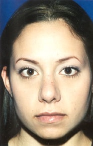 Buccal Fat Removal 01 After 1