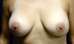 Breast Implant Exchange 01 Before