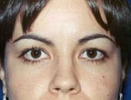 Eyelid Surgery 13 Before 1