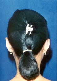 Otoplasty 01 After 2