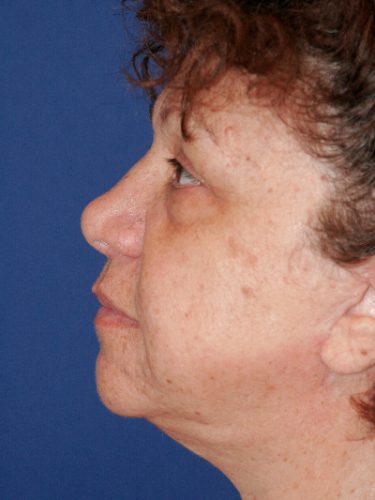 Neck Lift 02 After 2