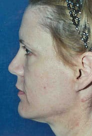 Facelift 09 Before 3