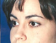 Eyelid Surgery 13 After 2