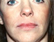 Lip Lift / Augmentation 02 Before 1