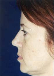 Facelift 06 Before 2