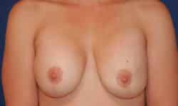 Breast Implant Removal 01 Before