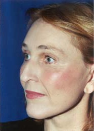 Brow Lift 01 After 2