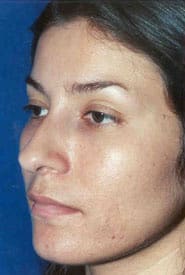 Rhinoplasty 09 Before 2