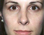 Rhinoplasty 04 After