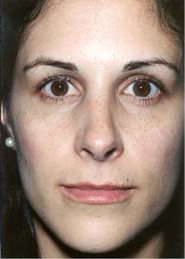 Rhinoplasty 04 After 1