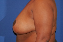 Breast Reduction 03 After 3