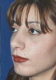 Rhinoplasty 03 After 2