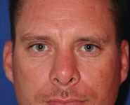 Chin Implants 01 Before