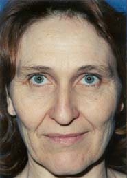 Brow Lift 01 Before 1