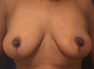 Breast Lift 02 After 1