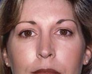 Chin Implants 03 After